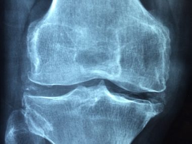 Osteoporosis and Arthritis: your bone and joints biggest problem